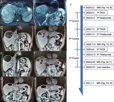 Case Report: Transarterial Chemoembolization in Combination With Tislelizumab Downstages Unresectable Hepatocellular Carcinoma Followed by Radical Salvage Resection